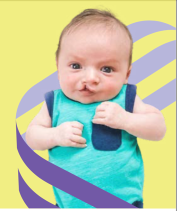Smiling baby with a cleft lip