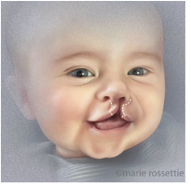 Illustration of a baby with a cleft lip