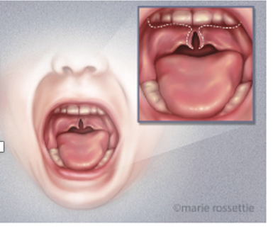 Illustration of a cleft palate inside the mouth