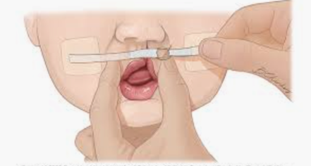 Illustration of a nasoalveolar molding (NAM) appliance