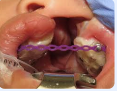 Latham appliance in a baby’s mouth