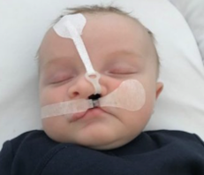 Baby with face taping