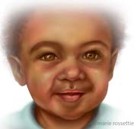 Illustration of a child with a cleft lip