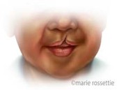 Illustration of a unilateral cleft lip