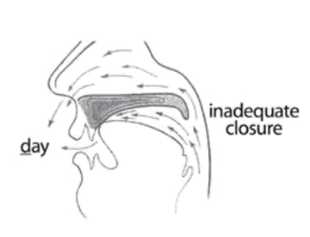 Diagram showing inadequate velopharyngeal closure