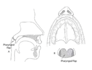 Diagram of a pharyngeal flap procedure