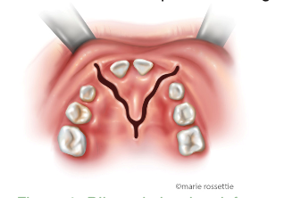 Illustration of a bilateral alveolar cleft
