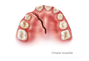 Illustration of a unilateral alveolar cleft