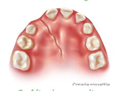 Illustration of an alveolar cleft in the upper gum
