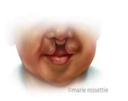 Illustration of a bilateral cleft lip