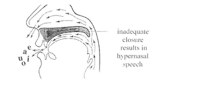 Diagram of inadequate closure resulting in hypernasal speech