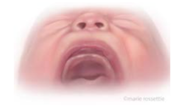 Illustration of a cleft of the soft palate