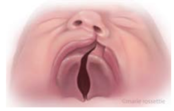 Illustration of a unilateral cleft palate