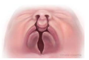 Illustration of a bilateral cleft palate